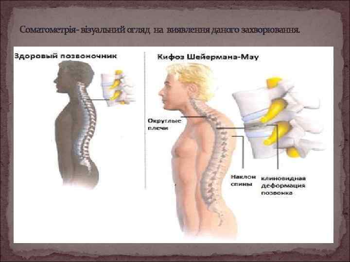 Болезнь мау. Операция при болезни Шейермана МАУ. Презентация болезнь Шойерман-МАУ. Шейермана МАУ рентген описание. Шейермана МАУ У взрослых протокол.