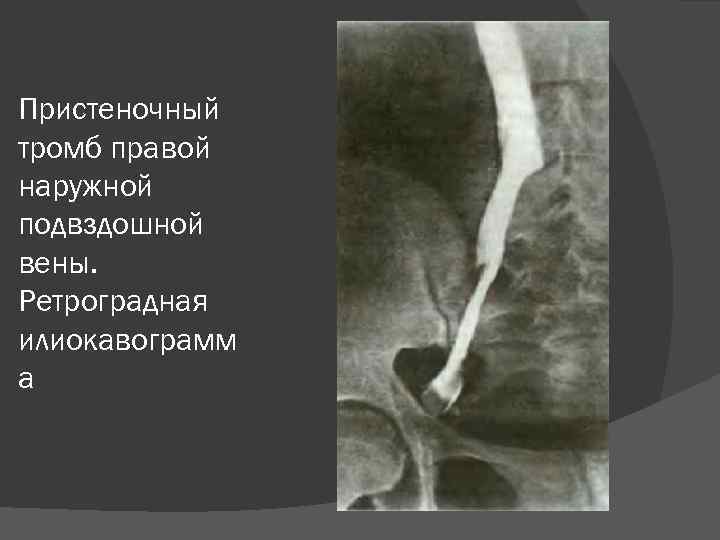 Пристеночный тромб правой наружной подвздошной вены. Ретроградная илиокавограмм а 