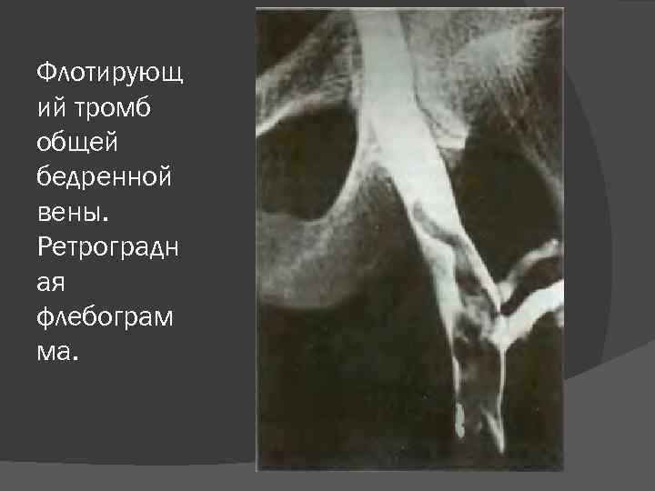 Флотирующ ий тромб общей бедренной вены. Ретроградн ая флебограм ма. 