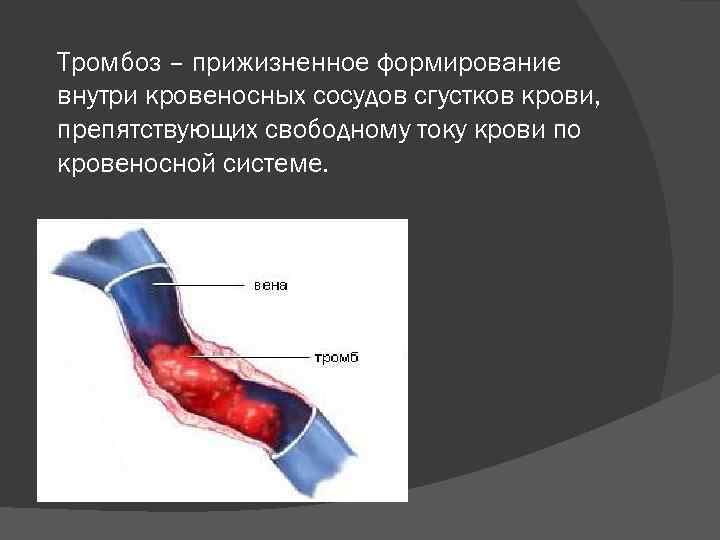 Тромбоз – прижизненное формирование внутри кровеносных сосудов сгустков крови, препятствующих свободному току крови по