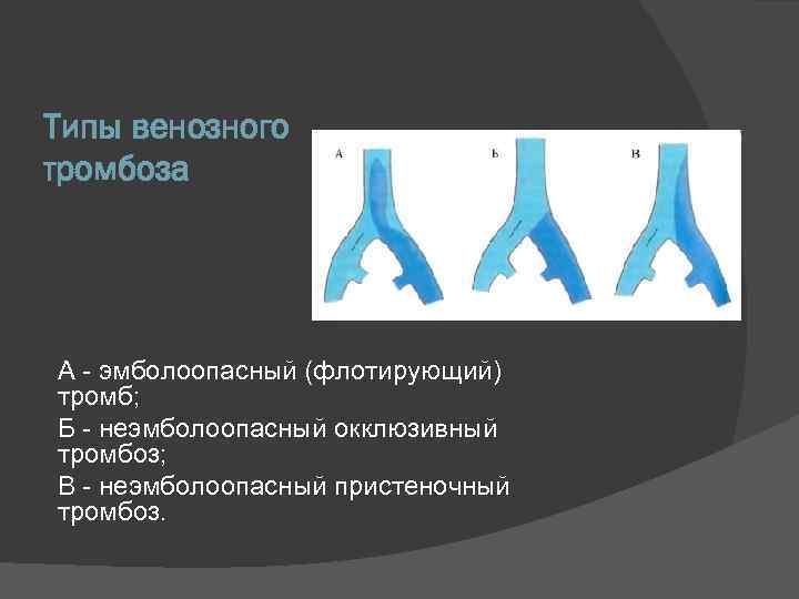 Окклюзирующий тромбоз. Флотирующий венозный тромбоз. Флотирующий и пристеночные тромбы. Флотирующий тромб классификация. Пристеночный , флотирующий венозный тромбоз окклюзионный.