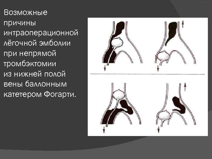 Возможные причины интраоперационной лёгочной эмболии при непрямой тромбэктомии из нижней полой вены баллонным катетером