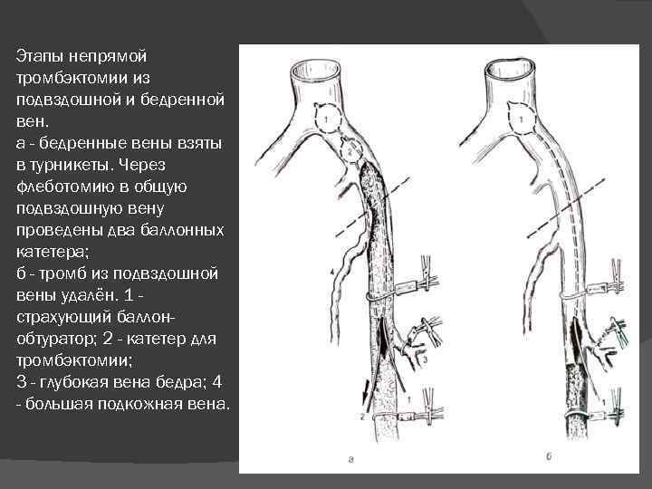 Катетер в бедренную вену