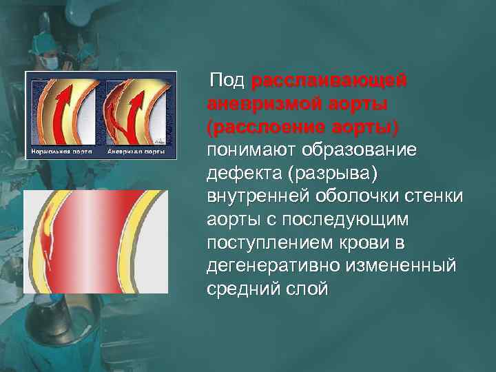  Под расслаивающей аневризмой аорты (расслоение аорты) понимают образование дефекта (разрыва) внутренней оболочки стенки