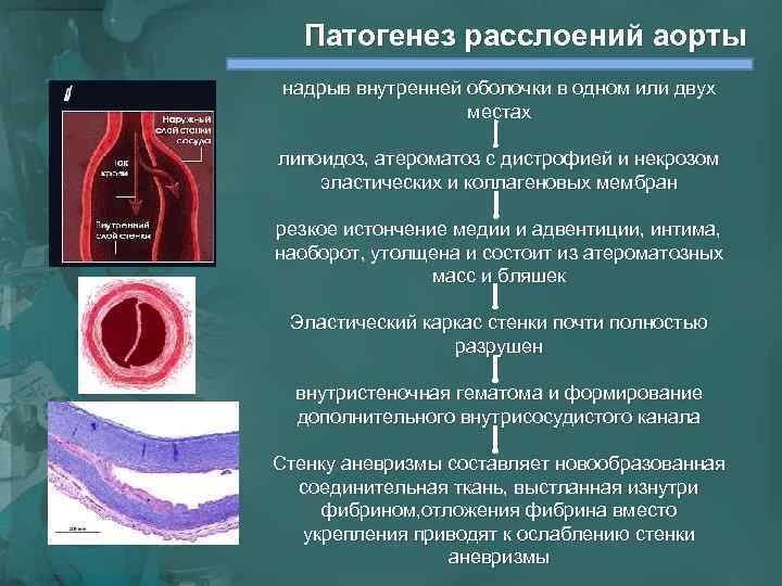 Патогенез расслоений аорты надрыв внутренней оболочки в одном или двух местах липоидоз, атероматоз с