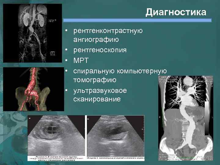 Диагностика • рентгенконтрастную ангиографию • рентгеноскопия • МРТ • спиральную компьютерную томографию • ультразвуковое