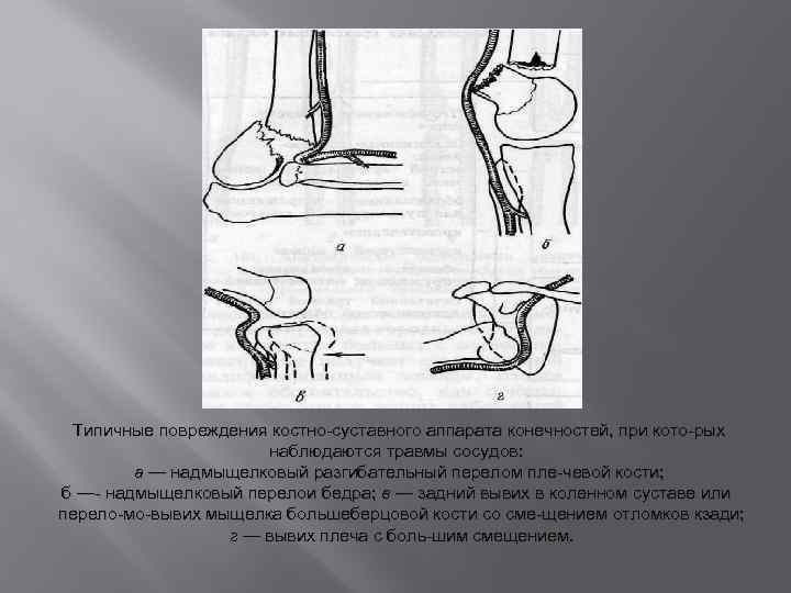 Типичные повреждения костно суставного аппарата конечностей, при кото рых наблюдаются травмы сосудов: а —