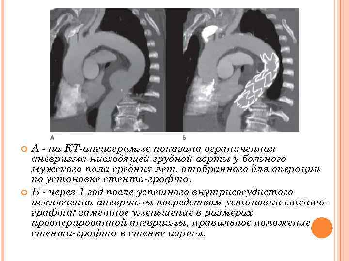 Расслаивающаяся аневризма аорты презентация