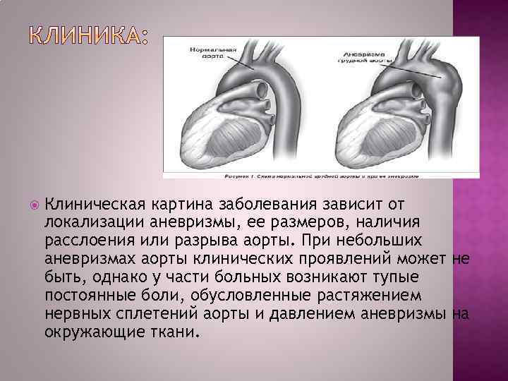  Клиническая картина заболевания зависит от локализации аневризмы, ее размеров, наличия расслоения или разрыва