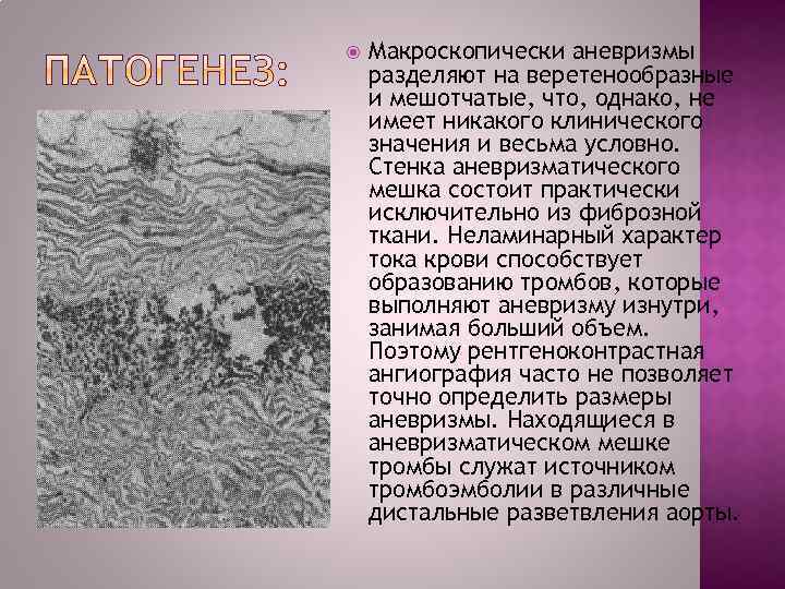  Макроскопически аневризмы разделяют на веретенообразные и мешотчатые, что, однако, не имеет никакого клинического