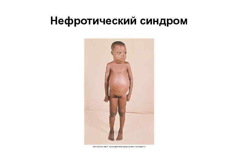 Нефротический синдром 