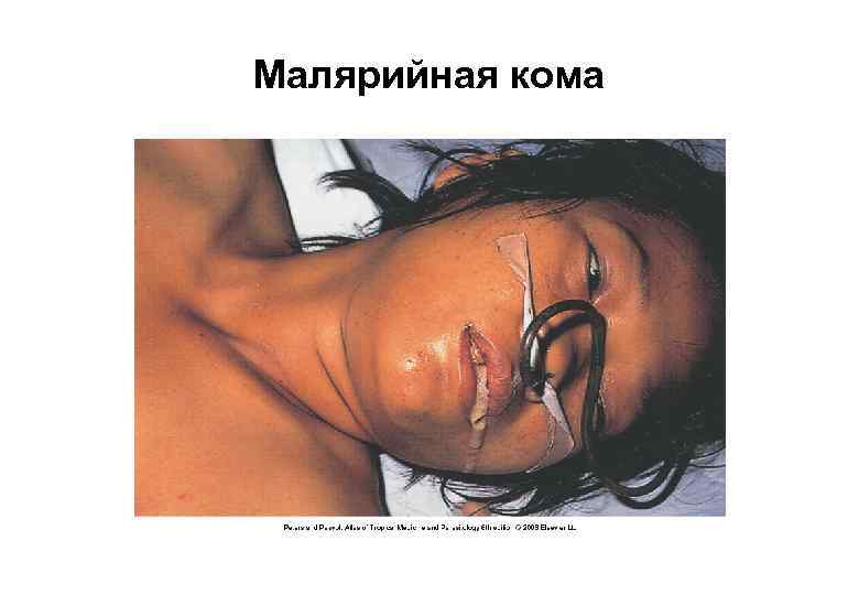 Малярийная кома 
