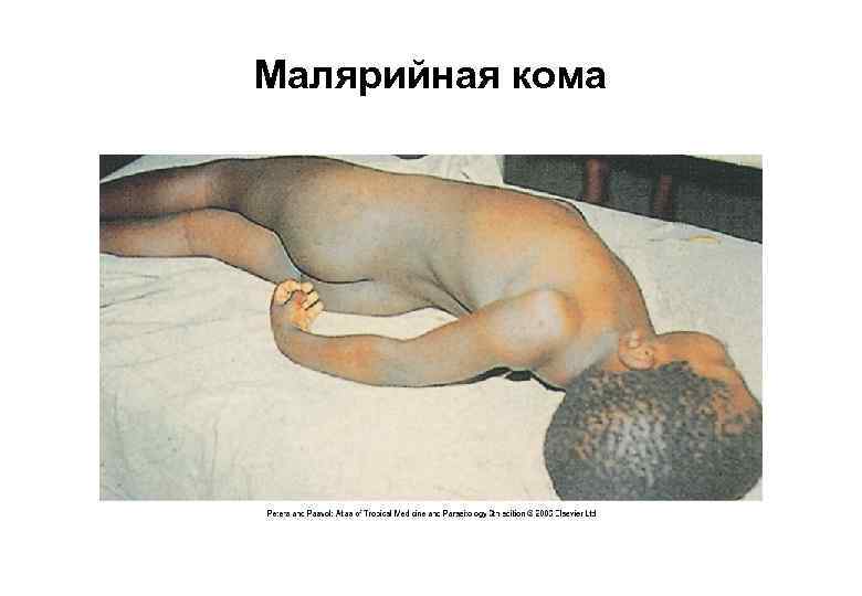 Малярийная кома 