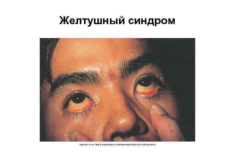 Желтушный синдром 