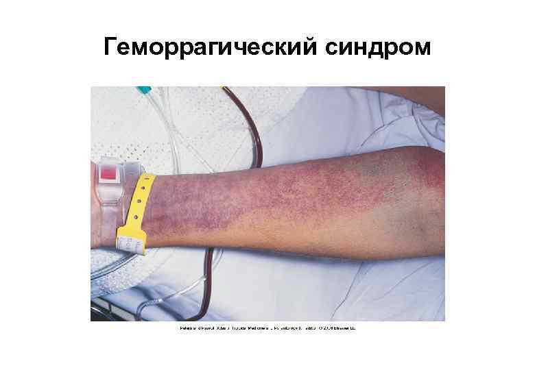 Геморрагический синдром 