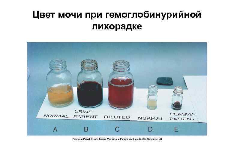 Цвет мочи при гемоглобинурийной лихорадке 