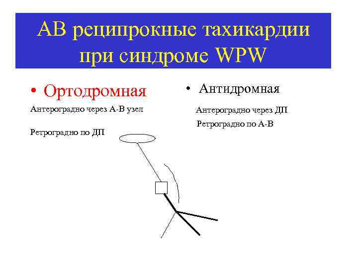 АВ реципрокные тахикардии при синдроме WPW • Ортодромная Антероградно через А В узел Ретроградно