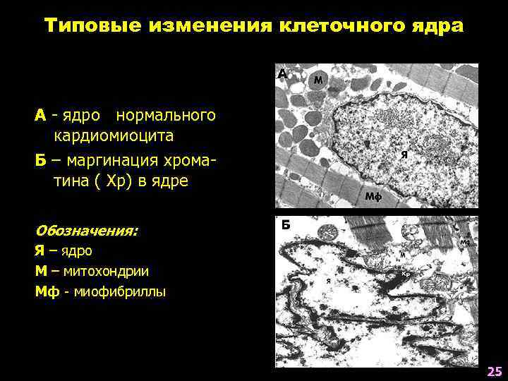 Типовые изменения клеточного ядра А - ядро нормального кардиомиоцита Б – маргинация хроматина (