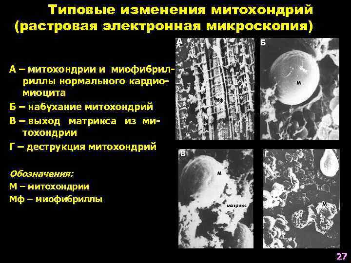 Типовые изменения митохондрий (растровая электронная микроскопия) А – митохондрии и миофибрилриллы нормального кардиомиоцита Б