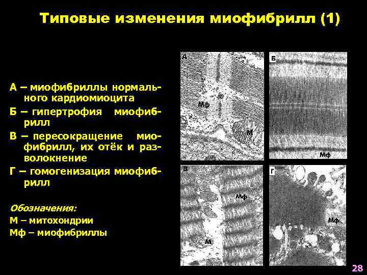 Типовые изменения миофибрилл (1) А – миофибриллы нормального кардиомиоцита Б – гипертрофия миофибрилл В