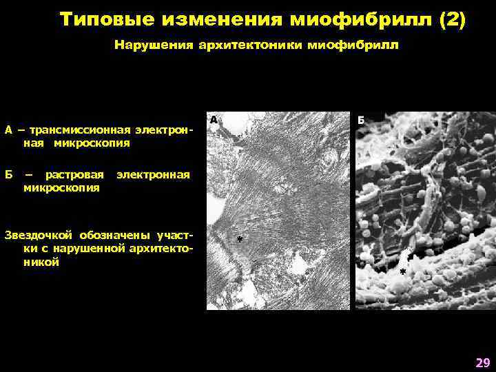 Типовые изменения миофибрилл (2) Нарушения архитектоники миофибрилл А – трансмиссионная электронная микроскопия Б –