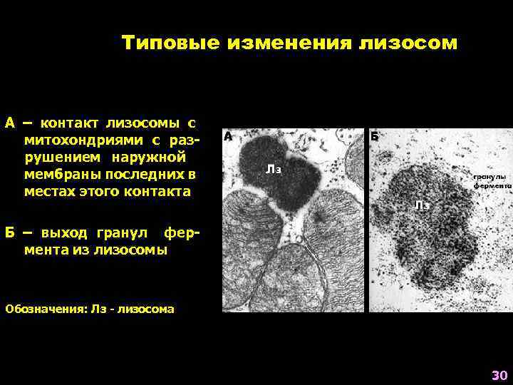 Типовые изменения лизосом А – контакт лизосомы с митохондриями с разрушением наружной мембраны последних