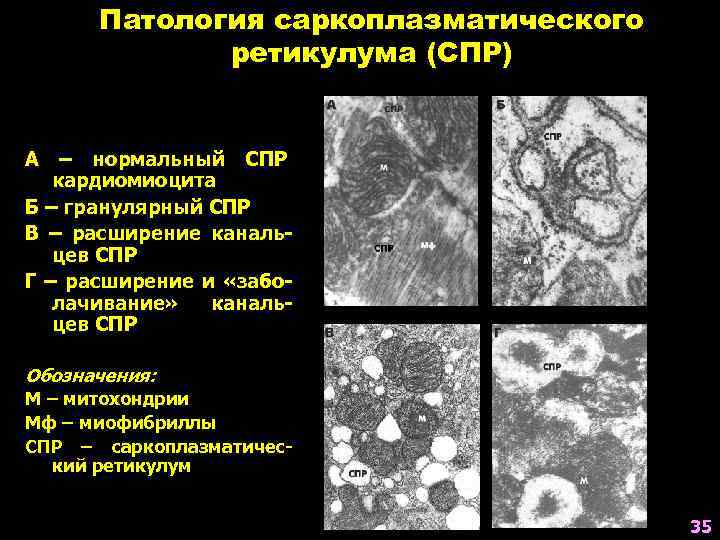 Патология саркоплазматического ретикулума (СПР) А – нормальный СПР кардиомиоцита Б – гранулярный СПР В