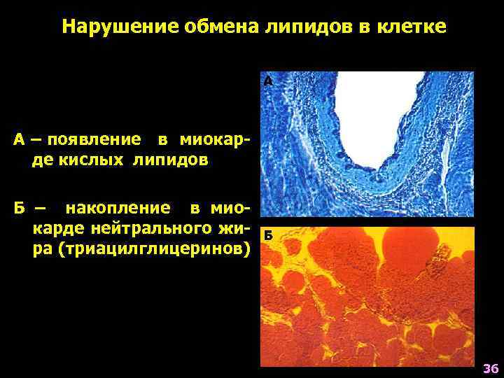 Нарушение обмена липидов в клетке А – появление в миокарде кислых липидов Б –