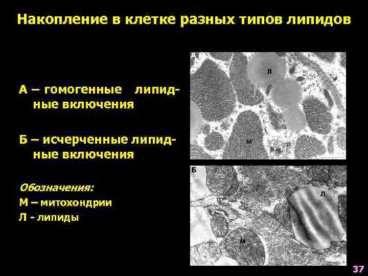 Накопление в клетке разных типов липидов А – гомогенные липидные включения Б – исчерченные