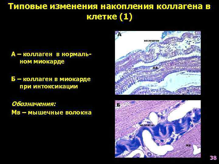 Типовые изменения накопления коллагена в клетке (1) А – коллаген в нормальном миокарде Б