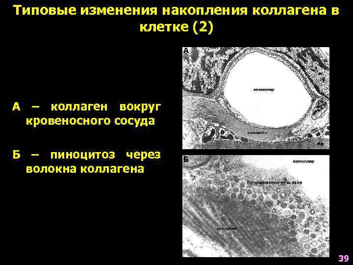 Типовые изменения накопления коллагена в клетке (2) А – коллаген вокруг кровеносного сосуда Б