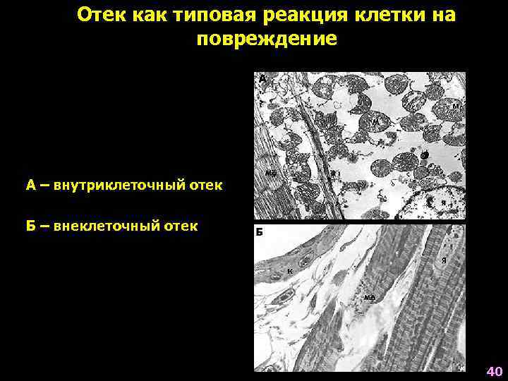 Отек как типовая реакция клетки на повреждение А – внутриклеточный отек Б – внеклеточный