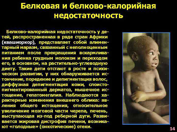 Белковая и белково-калорийная недостаточность Белково-калорийная недостаточность у детей, распространенная в ряде стран Африки (квашиоркор),