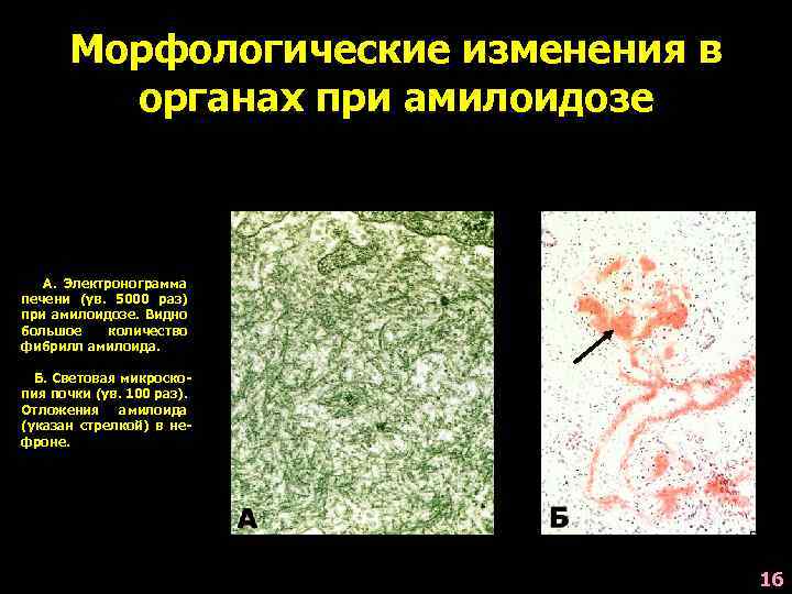 Амилоидоз клинические рекомендации