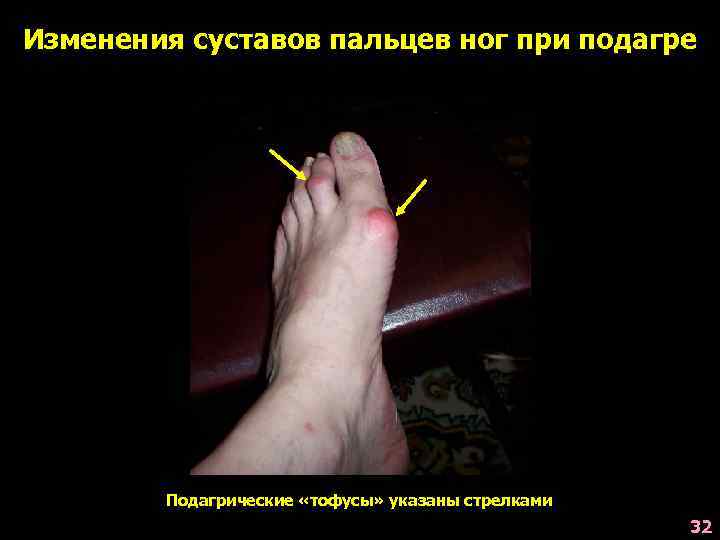 Изменения суставов пальцев ног при подагре Подагрические «тофусы» указаны стрелками 32 