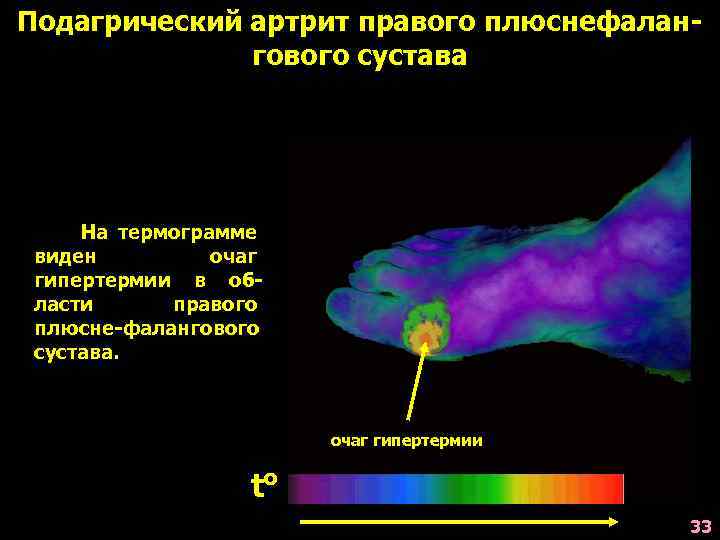 Подагрический артрит правого плюснефалангового сустава На термограмме виден очаг гипертермии в области правого плюсне-фалангового