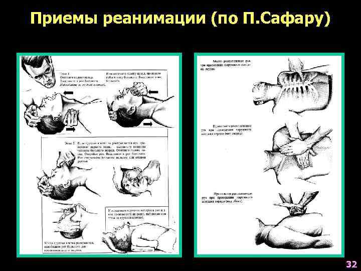 Приемы реанимации (по П. Сафару) 32 