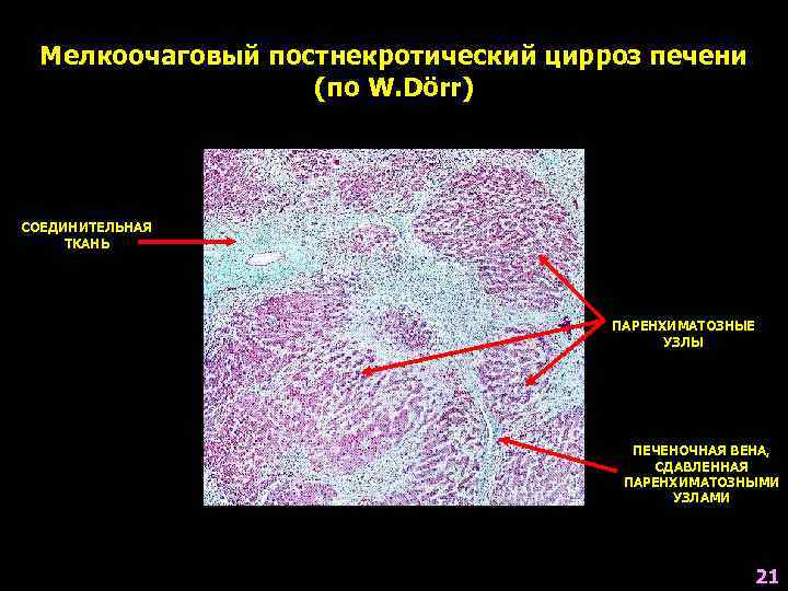 Мелкоочаговый постнекротический цирроз печени (по W. Dörr) СОЕДИНИТЕЛЬНАЯ ТКАНЬ ПАРЕНХИМАТОЗНЫЕ УЗЛЫ ПЕЧЕНОЧНАЯ ВЕНА, СДАВЛЕННАЯ