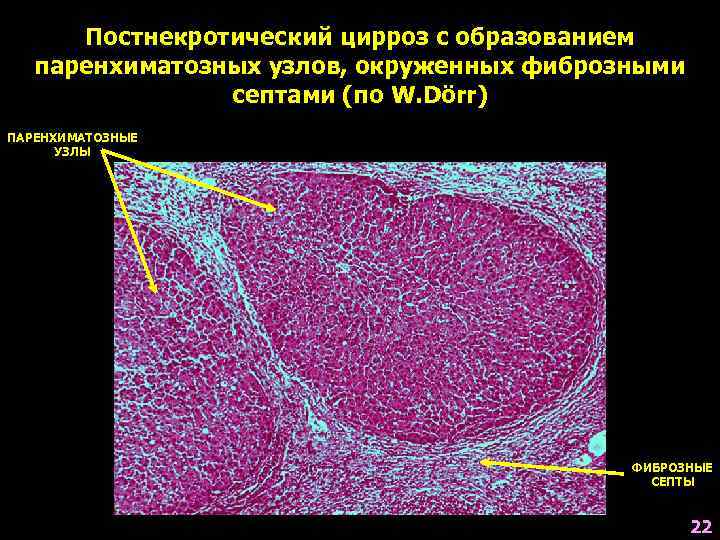 Постнекротический цирроз с образованием паренхиматозных узлов, окруженных фиброзными септами (по W. Dörr) ПАРЕНХИМАТОЗНЫЕ УЗЛЫ
