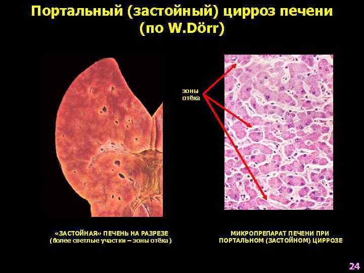 Портальный (застойный) цирроз печени (по W. Dörr) зоны отёка «ЗАСТОЙНАЯ» ПЕЧЕНЬ НА РАЗРЕЗЕ (более