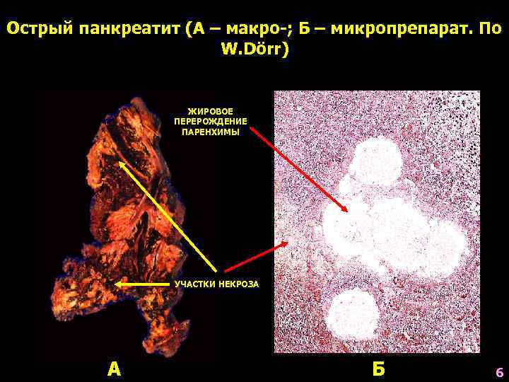 Острый панкреатит (А – макро-; Б – микропрепарат. По W. Dörr) ЖИРОВОЕ ПЕРЕРОЖДЕНИЕ ПАРЕНХИМЫ