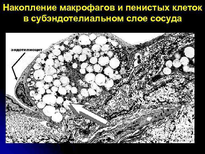 Накопление макрофагов и пенистых клеток в субэндотелиальном слое сосуда эндотелиоцит 