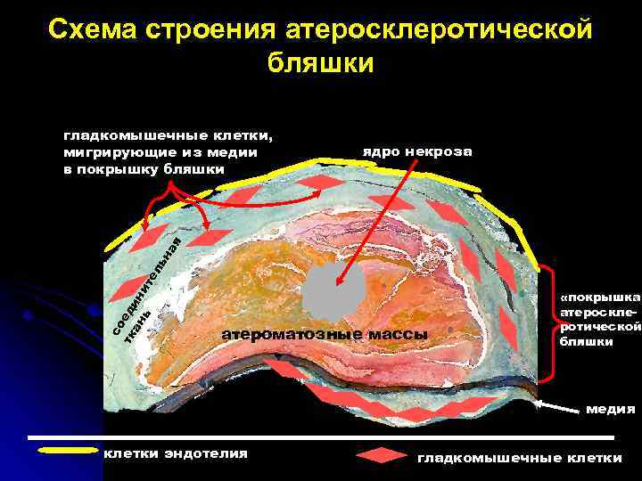 Схема строения атеросклеротической бляшки ядро некроза со тк еди ан н ь ит ел