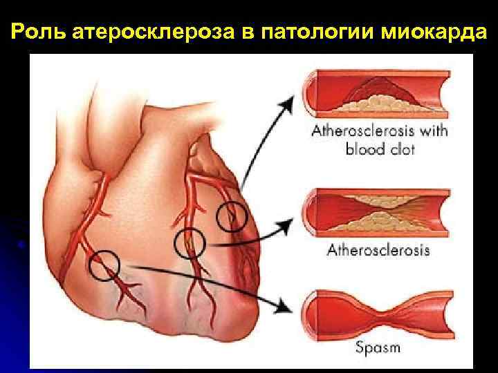 Роль атеросклероза в патологии миокарда 