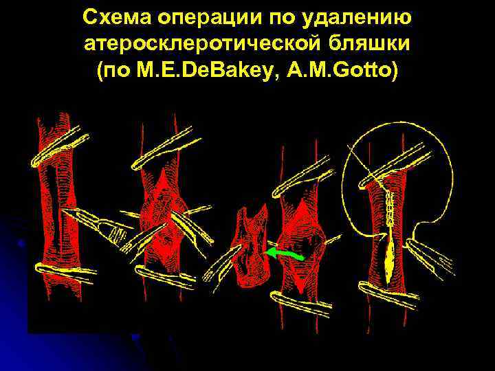 Схема операции по удалению атеросклеротической бляшки (по M. E. De. Bakey, A. M. Gotto)