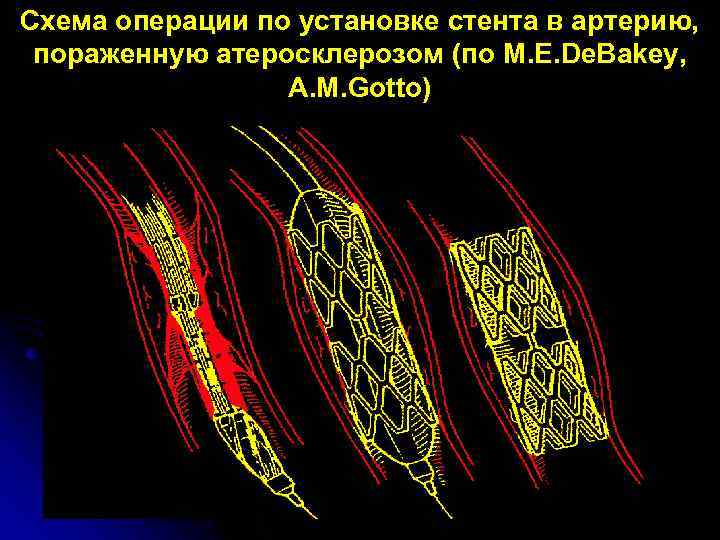 Схема операции по установке стента в артерию, пораженную атеросклерозом (по M. E. De. Bakey,