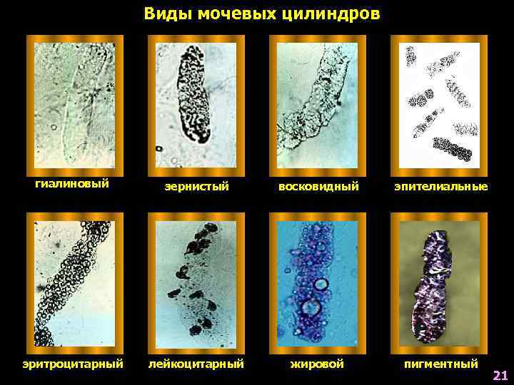 Виды мочевых цилиндров гиалиновый зернистый восковидный эпителиальные эритроцитарный лейкоцитарный жировой пигментный 21 