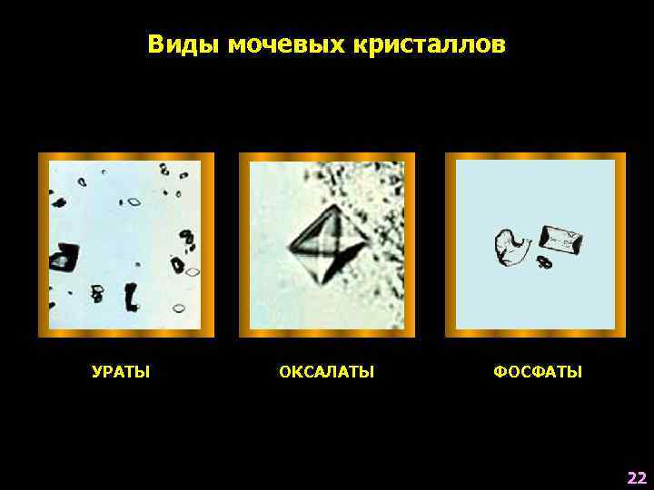 Виды мочевых кристаллов УРАТЫ ОКСАЛАТЫ ФОСФАТЫ 22 