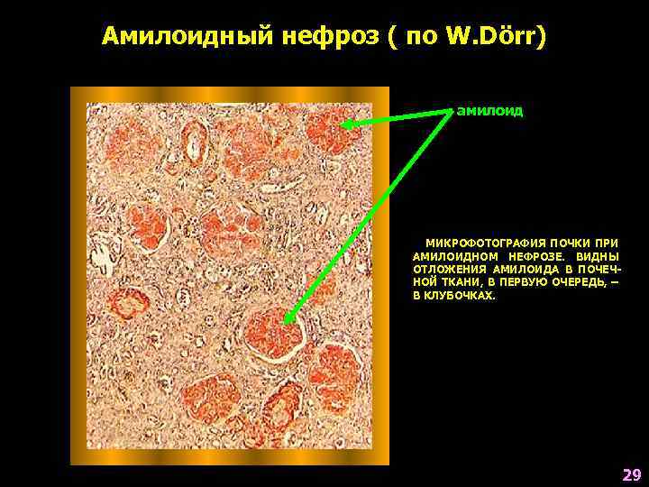 Амилоидоз почки рисунок