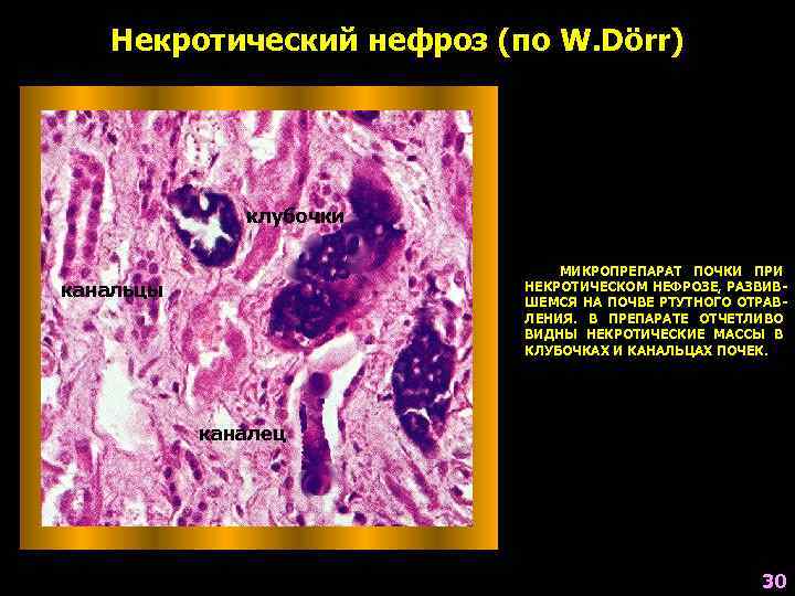 Нефроз почек